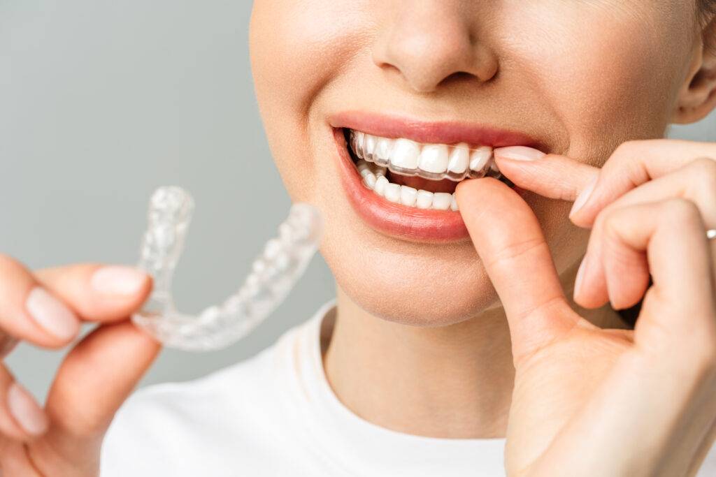 Step:3   Elevate Your Smile With SA-Aligners